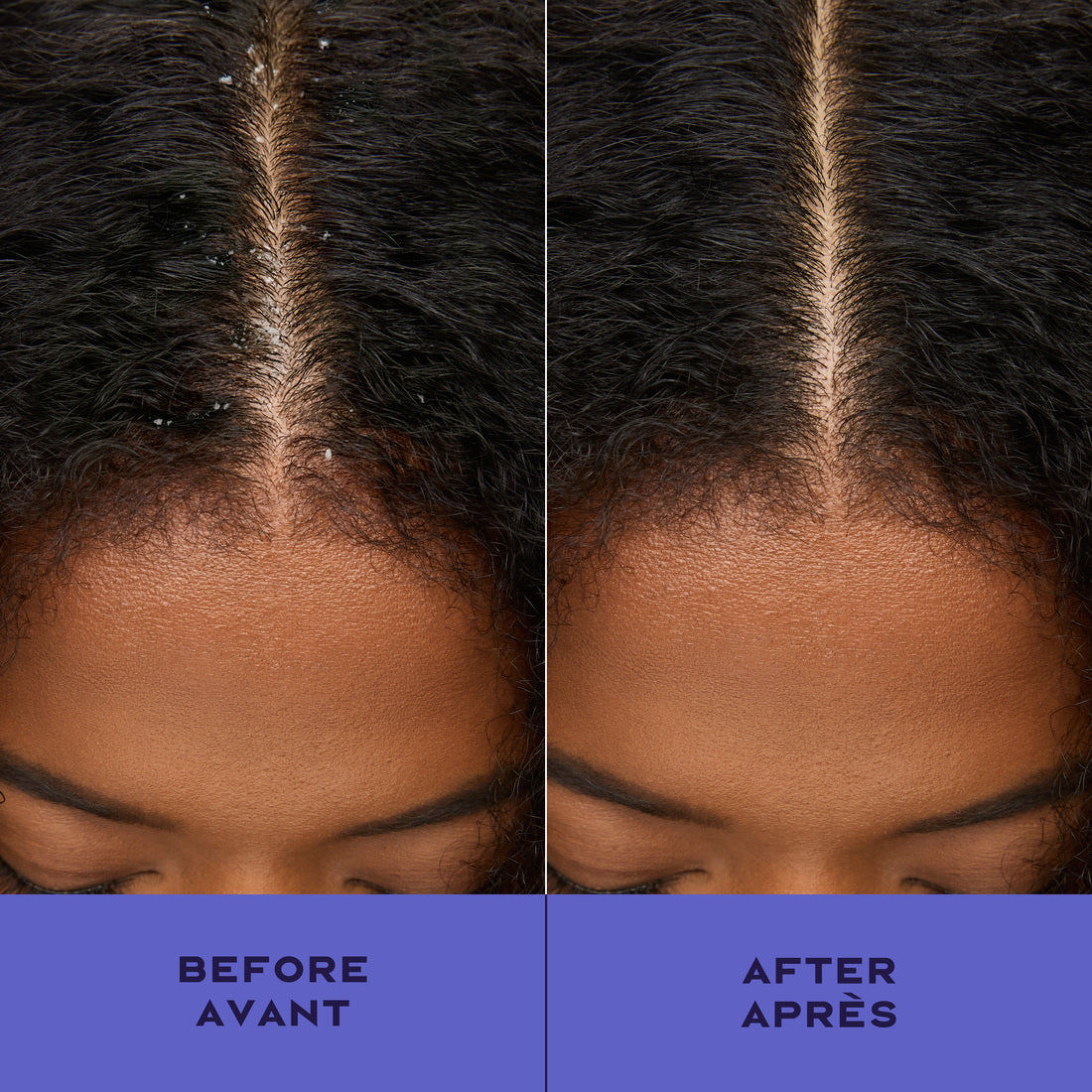 APPLE CIDER VINEGAR ANTI DANDRUFF SPRAY